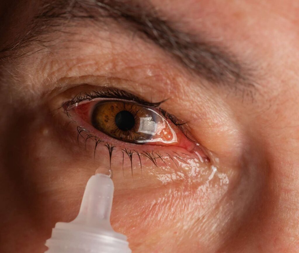 US FDA Urges Caution: Avoid Select Eye Drops Amidst Growing Infection Concerns